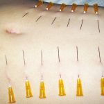 BDSM video A needle sticks in an abdomen.　腹に針