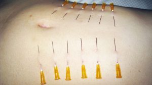BDSM video A needle sticks in an abdomen.　腹に針